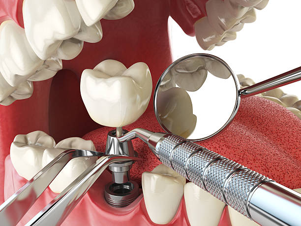 Best Emergency Dental Care for Broken or Chipped Teeth in Neffs, OH